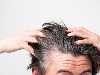 白髪と薄毛を気にする男性の頭