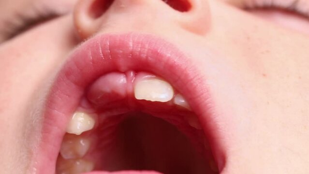 Close up video of little child toothless mouth, showing milk temporary teeth and tooth loss, exchanging by finger. New tooth growing up. Dentist appointment and dental care, oral hygiene for children