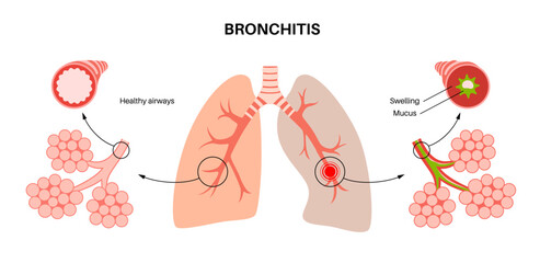Bronchitis lung disease - obrazy, fototapety, plakaty