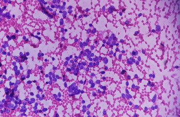 USG guided FNA cytology of liver SOL showing Non Hodgkin lymphoma. Metastatic carcinoma.