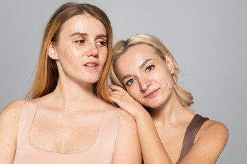 Freckled woman standing near friend with acne on face isolated on grey.