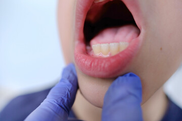 dentist, doctor examines oral cavity of small patient, boy 9-10 years opened mouth, oral cavity,...