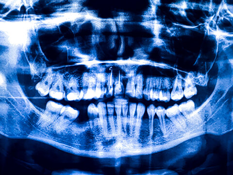 Panoramic dental tooth X-ray. Radiography for dental structures research concept.