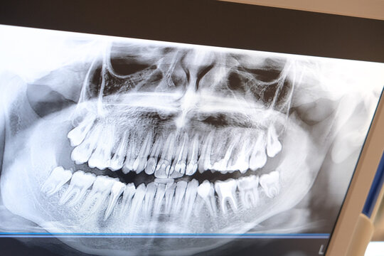 Close up tooth rontgen at digital screen of dentist clinic. Sample of tooth rontgen. Selective focus of area.