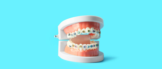 Model of jaw with braces on blue background