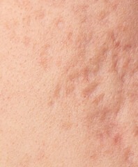 Fototapeta premium Acne scars on the skin. Macro.
