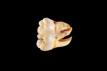 Geminated number 48 lower wisdom tooth posed on a black background. Dental phenomenon that appears to be two teeth developed from one. 
