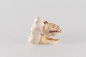 Geminated number 48 lower wisdom tooth posed on a white background. Dental phenomenon that appears to be two teeth developed from one. 