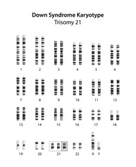 Down syndrome (trisomy 21) human karyotype	