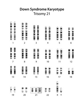 Down syndrome (trisomy 21) human karyotype	