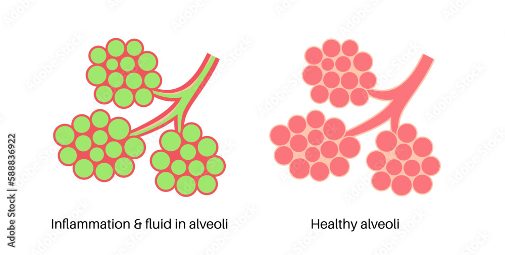 Poster Pneumonia infection poster