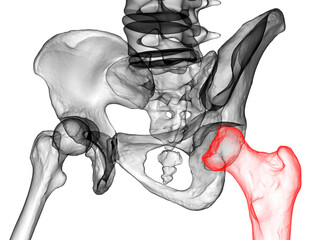 Femur bone affected by Legg-Calve-Perthes Disease, a childhood hip disorder, 3D illustration - obrazy, fototapety, plakaty