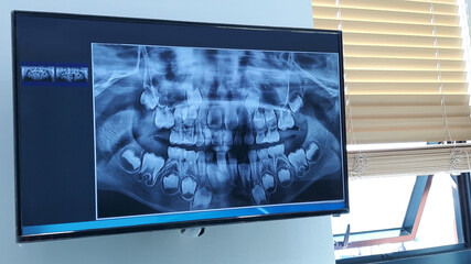 Dental panoramic x-ray in viewer 