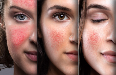 Half faces of girls suffering from rosacea