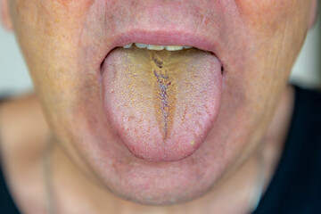 A man open his mouth stick out the tongue from, White tongue is  is poor oral hygiene, The result of an overgrowth and swelling of the fingerlike projections (papillae) on the surface of your tongue.