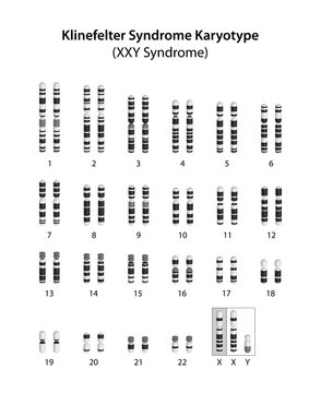 Klinefelter syndrome (XXY syndrome) karyotype.