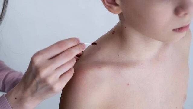 Mom lubricates the rash from chickenpox on son's body and back with with red antiseptic using cotton buds.11-year-old boy suffers from chickenpox. Varicella blisters lubricated with antiseptic drug,