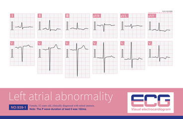 The electrocardiogram characteristics of left atrial abnormality are P wave duration greater than 120ms, P wave notch, peak to peak interval greater than or equal to 40ms, and increased PtfV1.