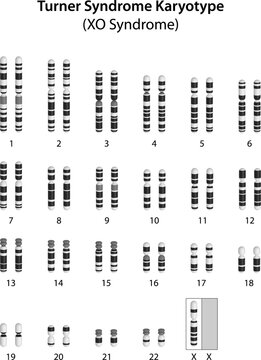 Turner syndrome (X0) human karyotype
