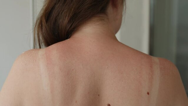 Woman removes her long hair from back with hand, medium shot. Dry, flaky skin with redness and pale spots from swimsuit straps after prolonged sun exposure.