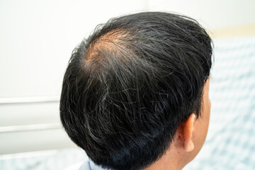 Bald at front of head and begin no loss hair glabrous of mature Asian business smart active office man.