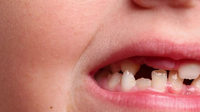 Close up unrecognizable little child toothless mouth showing teeth and gingiva with missing tooth. Milk temporary tooth loss after surgery operation. Oral hygiene and health care. Crooked, wonky teeth