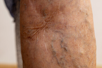 Cropped bare leg with scar after surgeon operation for blood vessels, protruding varicose veins....