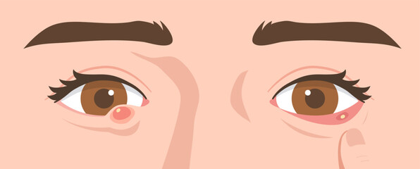 Illustration of eyes with external and internal stye. Concept of infectious eye, Hordeolum, Ophthalmology, infection, health, medicine. Flat vector illustration.