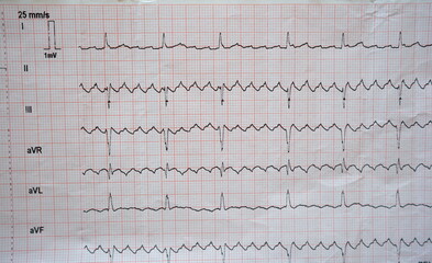 real ecg showing atrial flutter (good to see in serrated waves in II, III and aVF). - obrazy, fototapety, plakaty
