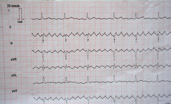real ecg showing atrial flutter (good to see in serrated waves in II, III and aVF).