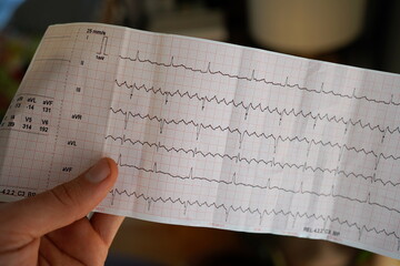 Hand holding a real electrocardiogram with atrial flutter.  - obrazy, fototapety, plakaty
