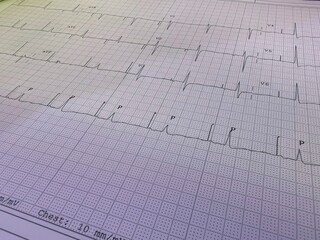 Close up of an electrocardiogram in paper form.