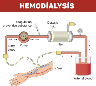 
illustration of a hemodialysis device - Vascular access kidney graft shunt lumen PICC line tube chest care artery vein arm Blood vessel flow neck liver CRRT intravenous injection Total Nutrition