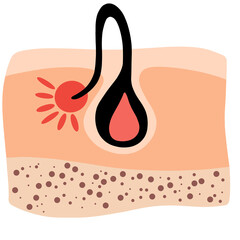 Ingrown hair. Inflammation, skin problems. Anatomy infographics of hair. Flat illustration isolated on the white background.