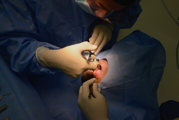 Local anesthesia for a dental implant placement