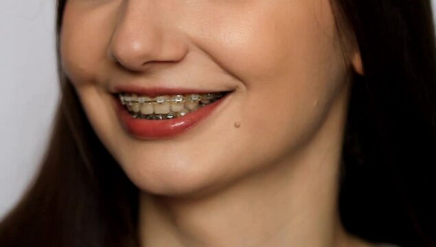 Female smile with dental braces close up. Smiling girl with brackets for teeth. Smiling woman. Braces Mouth
