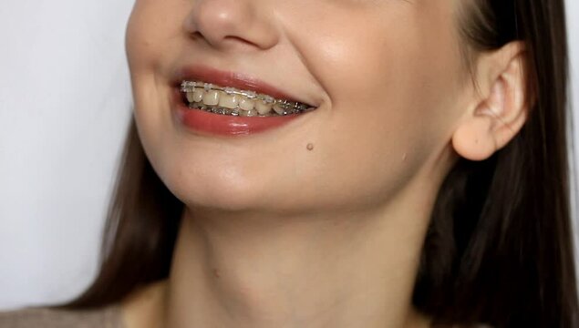 Female smile with dental braces close up. Smiling girl with brackets for teeth. Smiling woman. Braces Mouth