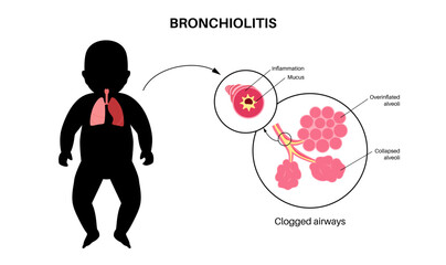 Bronchiolitis lung disease - 589628952
