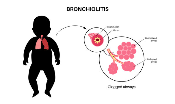 Bronchiolitis lung disease