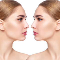 Young woman with bruises under eyes before and after treatment.