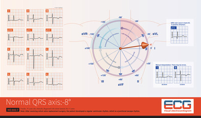 When the frontal QRS axis is located at -8°, the maximum ventricular depolarization potential is oriented towards lead I, and the R wave amplitude of lead I is the highest.