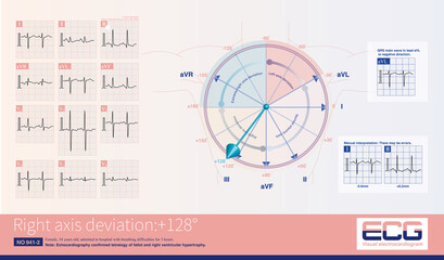 SⅠQⅢTⅢ sign is an electrocardiogram change of right heart disease, which is not only seen in acute pulmonary embolism, but also in other diseases affecting the right heart.