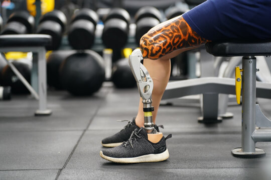 Young female with one prosthetic leg with the practice of using prosthetic legs to walk, exercise and and daily activities - Powered by Adobe