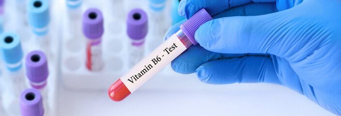 Fototapeta premium Doctor holding a test blood sample tube with Vitamin B6 test on the background of medical test tubes with analyzes.Banner.