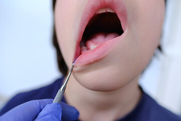 dentist, doctor examines oral cavity of small patient, closeup part of boy of 10 years old, concept pediatric dentistry, dental treatment, correction of occlusion, oral care, caries prevention