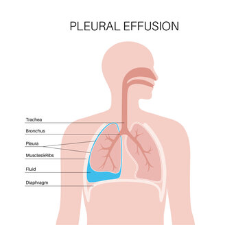 Pleural effusion poster