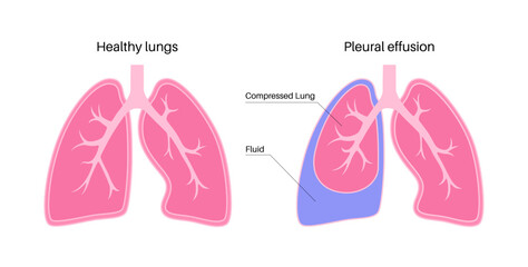 Pleural effusion poster