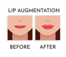 Vector illustration of Lips augmentation on women face. Before and After procedure Lip filler injections. Close up view. For advertising of medicinal, pharmacy, cream, lotion, cosmetic plastic surgery