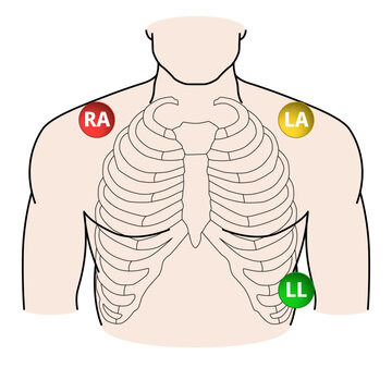 ECG 3-Wire Cable Lead Position - RA,LA,LL - Vector Medical Illustration