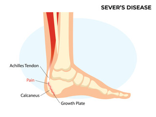 Sever's disease, calcaneal apophysitis. Ankle injury broken bone